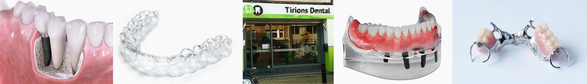 Header Dentaal bedrijf Tirions Dental - Kunstgebit Aarschot